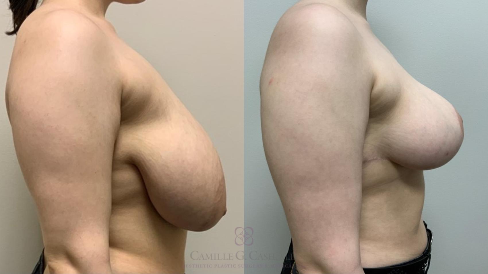 Before & After Breast Reduction Case 551 Left Side View in Houston, TX