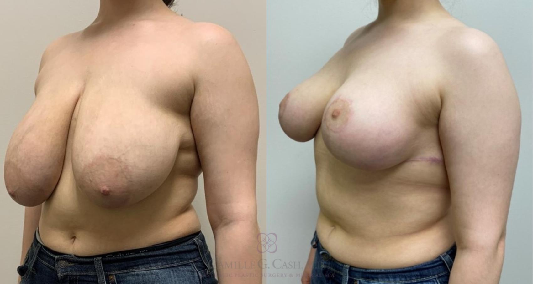 Before & After Breast Reduction Case 551 oblique 6 months View in Houston, TX