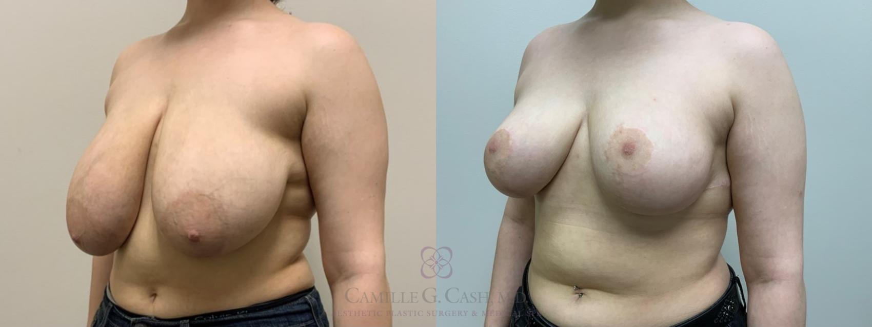 Before & After Breast Reduction Case 551 Right Oblique View in Houston, TX