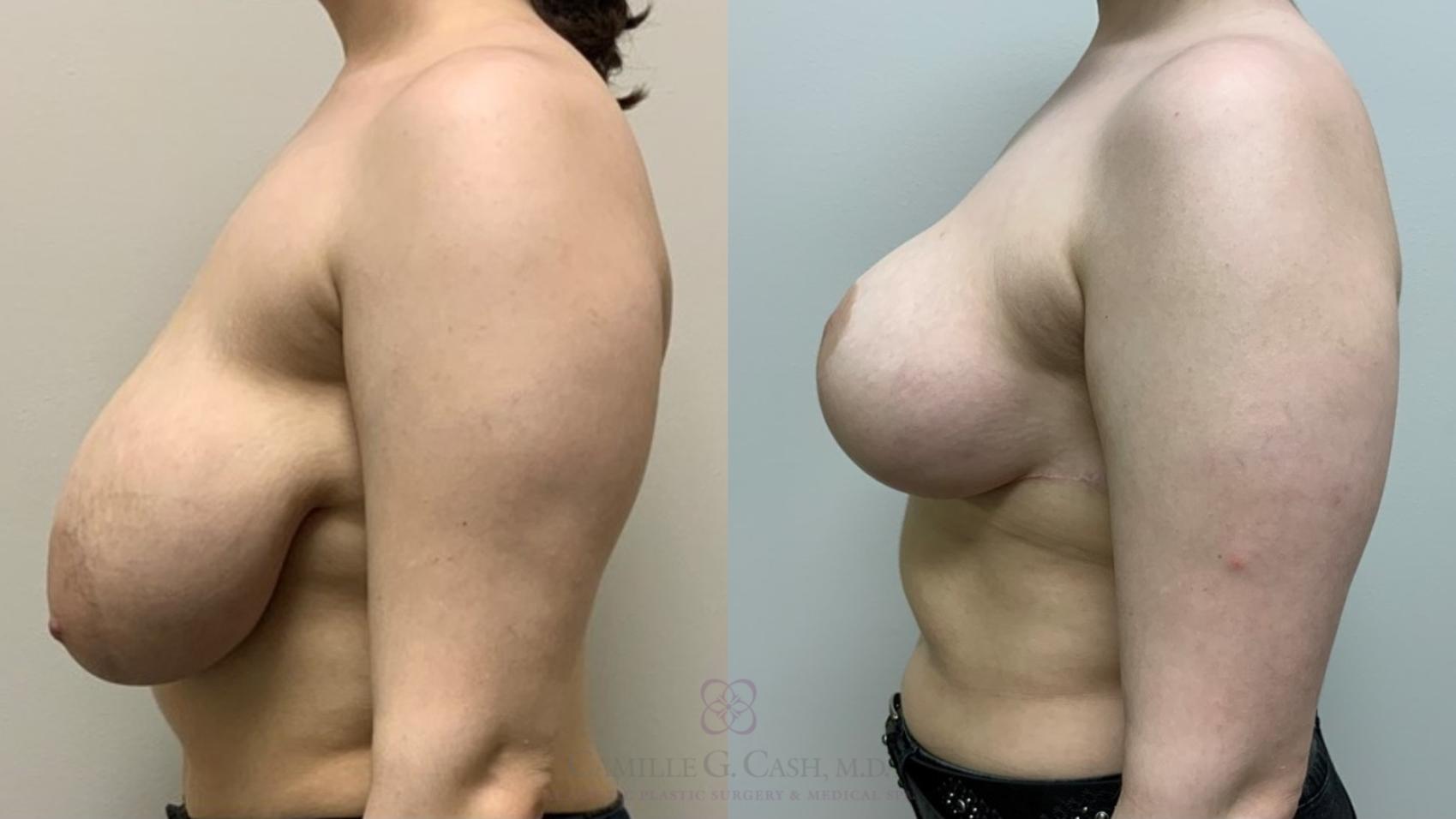 Before & After Breast Reduction Case 551 Right Side View in Houston, TX