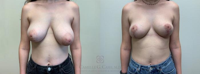 Before & After Breast Lift Case 556 front 6 months after View in Houston, TX