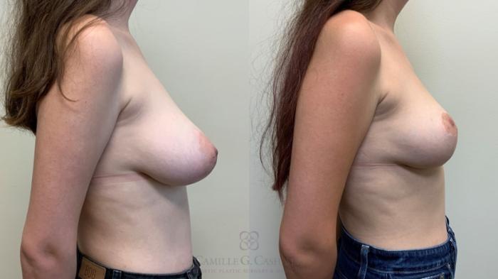 Before & After Breast Lift Case 556 Left Side View in Houston, TX