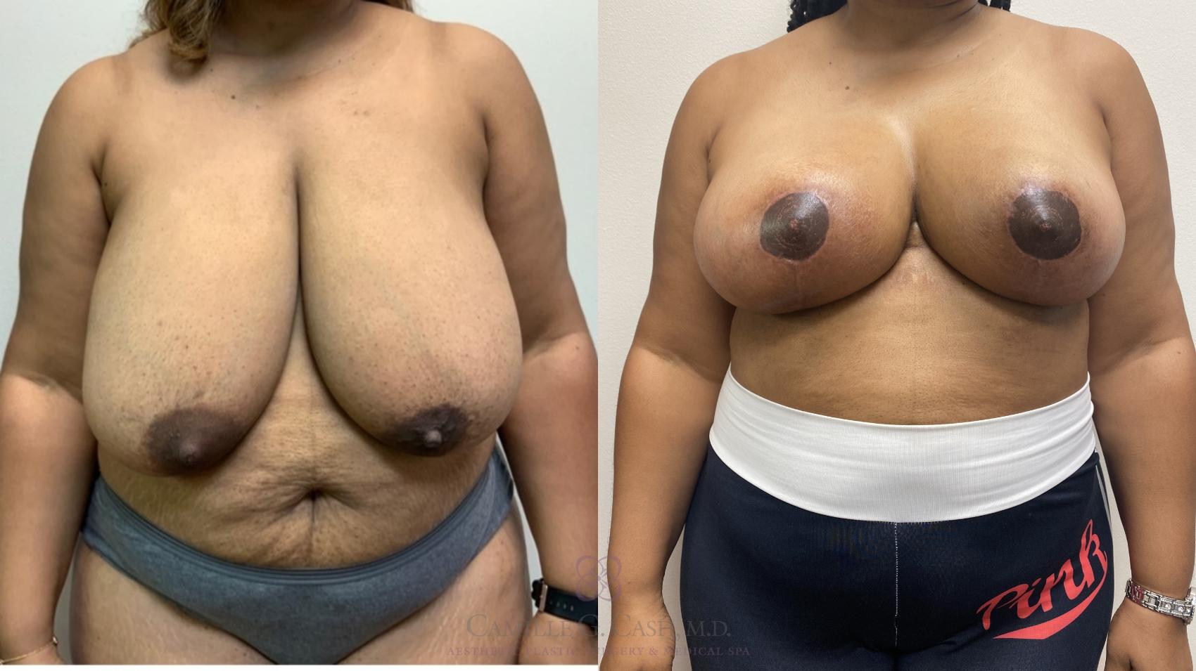 Before & After Breast Reduction Case 567 Front View in Houston, TX