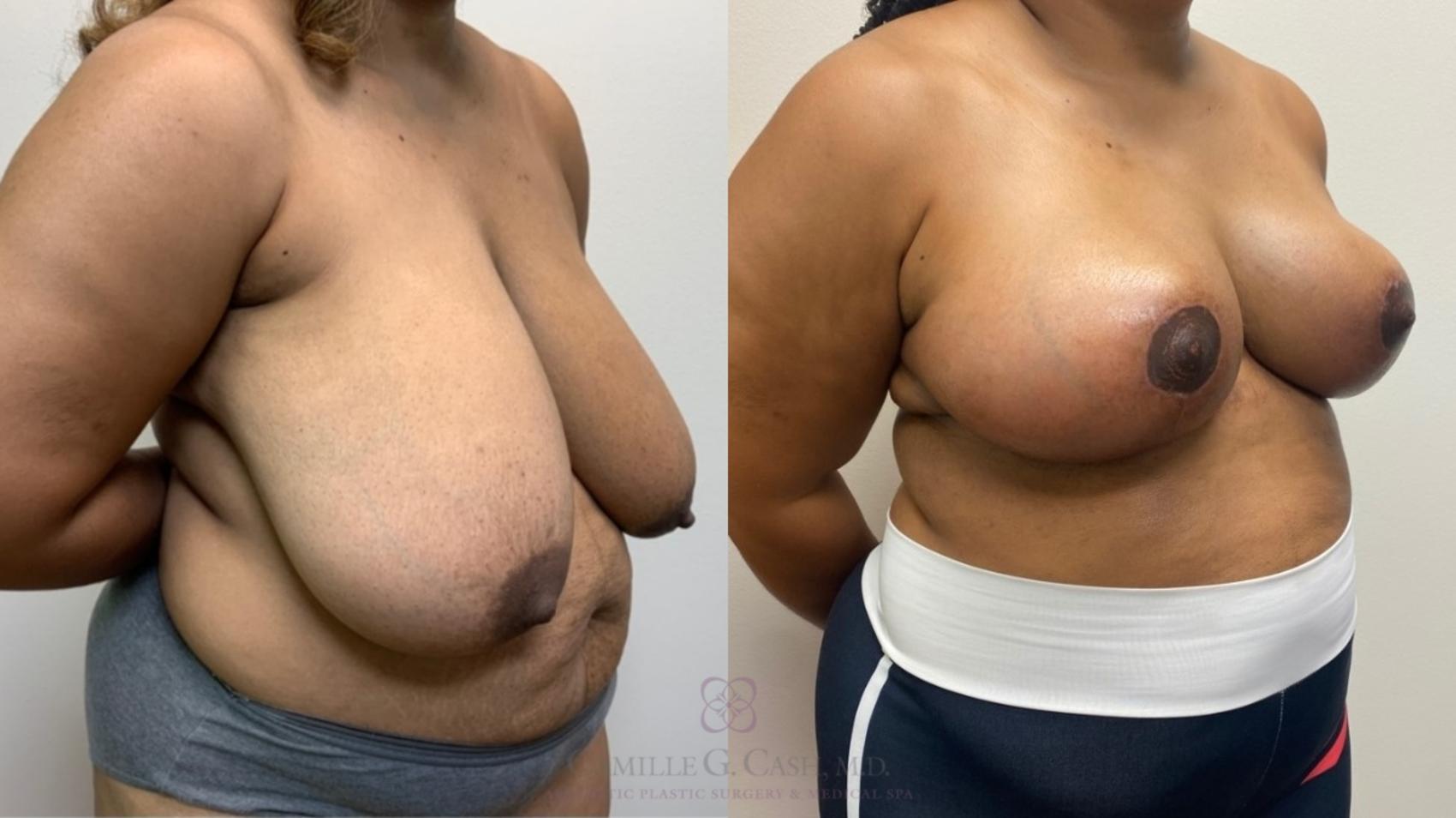 Before & After Breast Reduction Case 567 Left Oblique View in Houston, TX