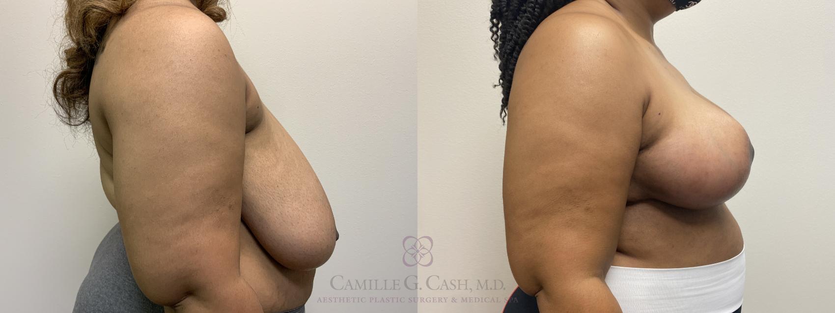 Before & After Breast Reduction Case 567 Left Side View in Houston, TX