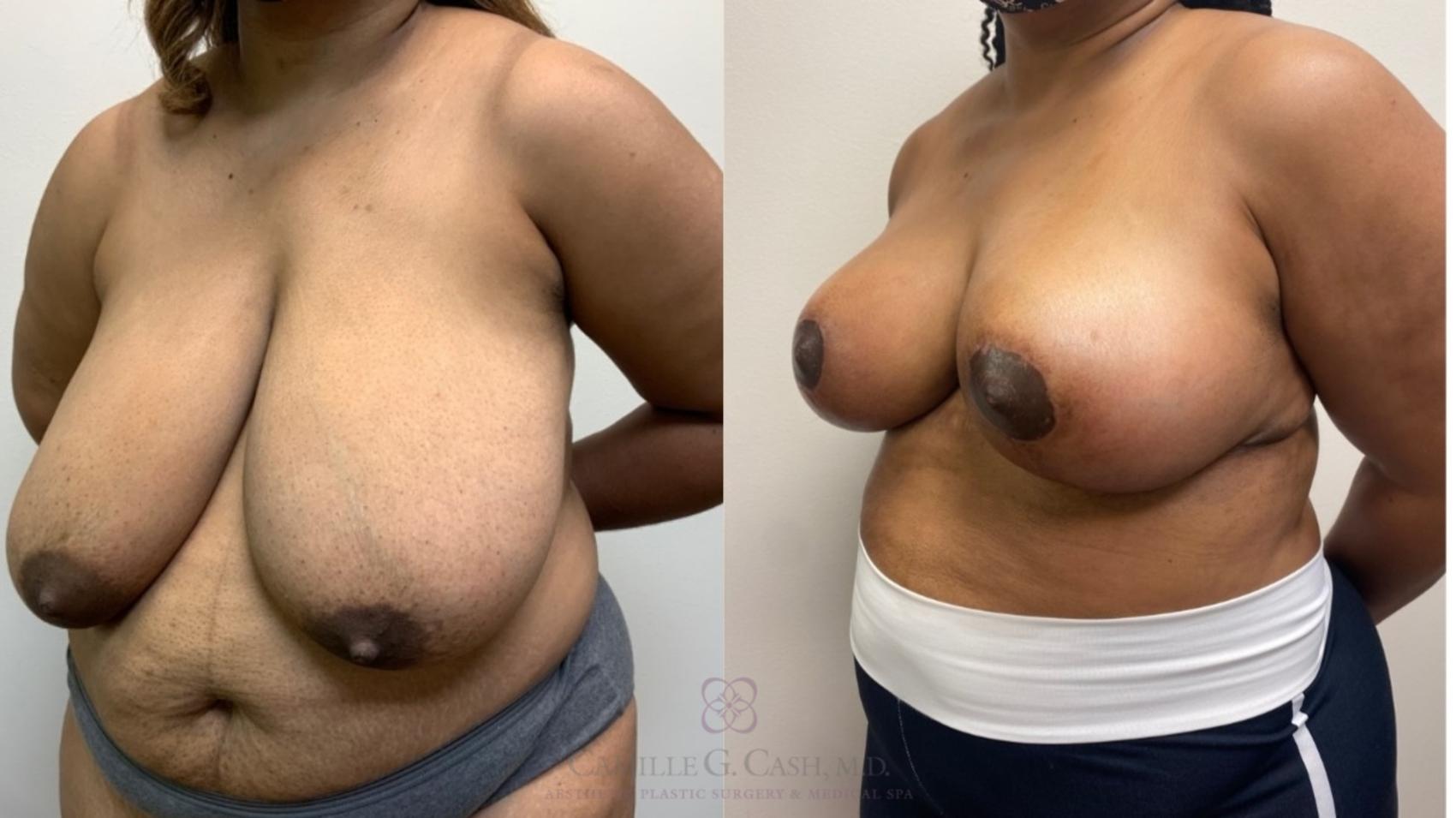 Before & After Breast Reduction Case 567 Right Oblique View in Houston, TX