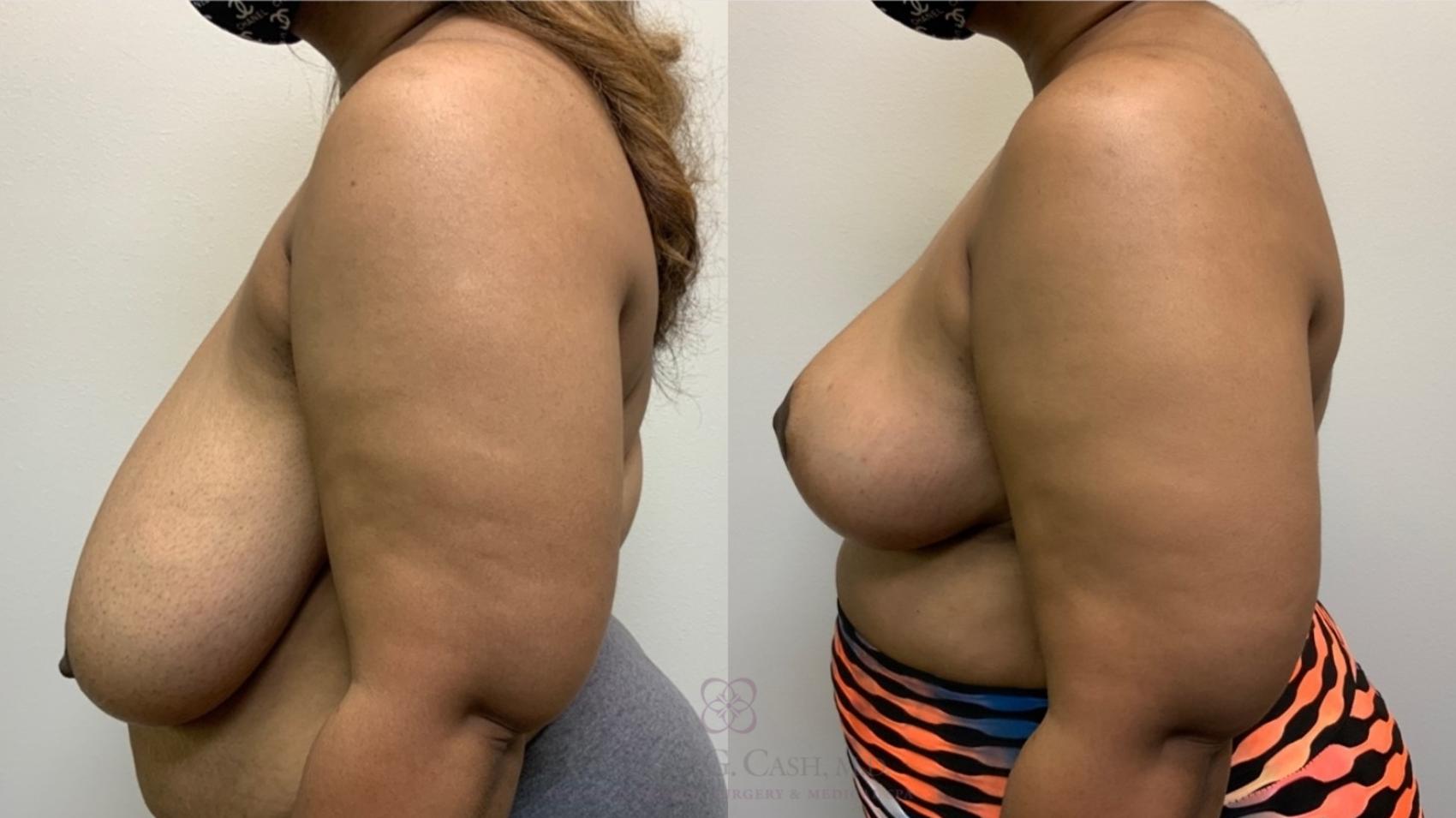 Before & After Breast Reduction Case 567 Right Side View in Houston, TX