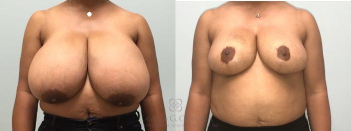 Before & After Breast Reduction Case 575 front 2 y View in Houston, TX