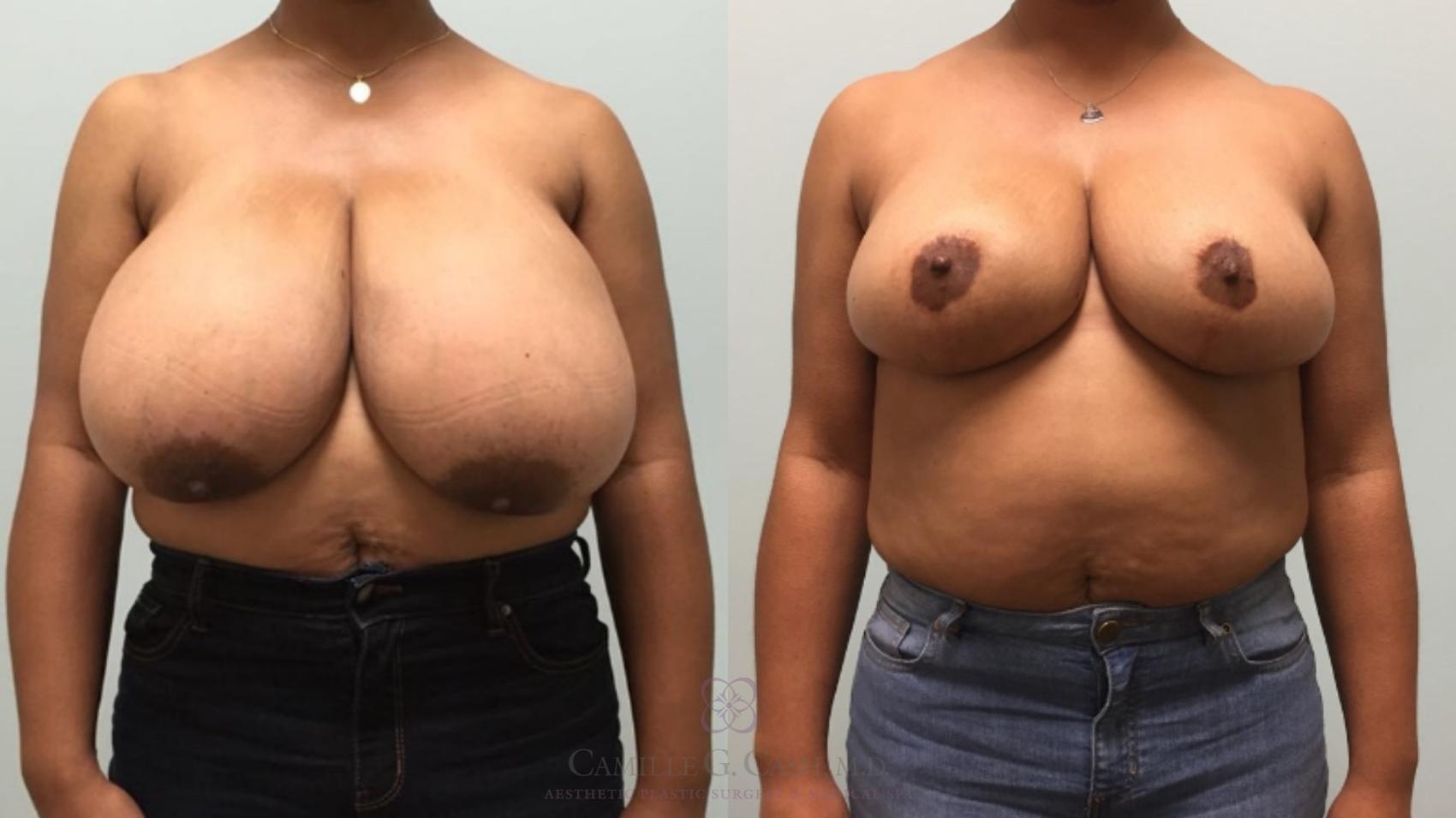 Before & After Breast Reduction Case 575 Front View in Houston, TX