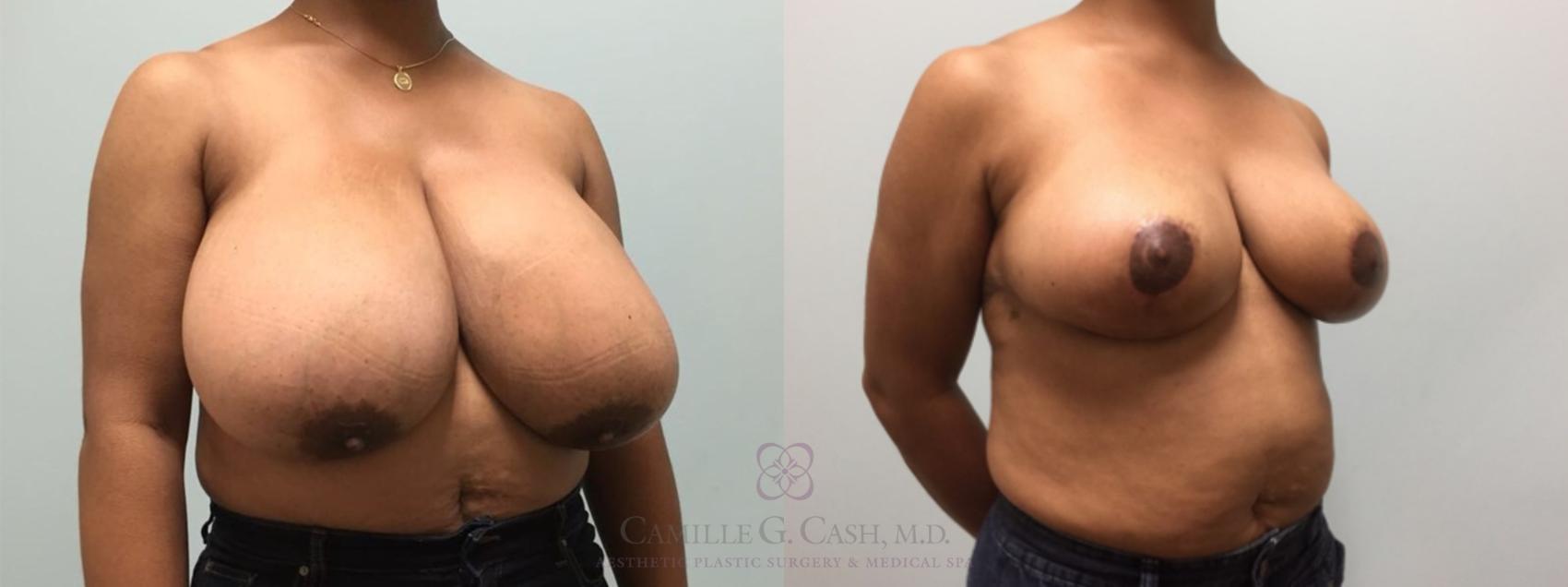 Before & After Breast Reduction Case 575 Left Oblique View in Houston, TX