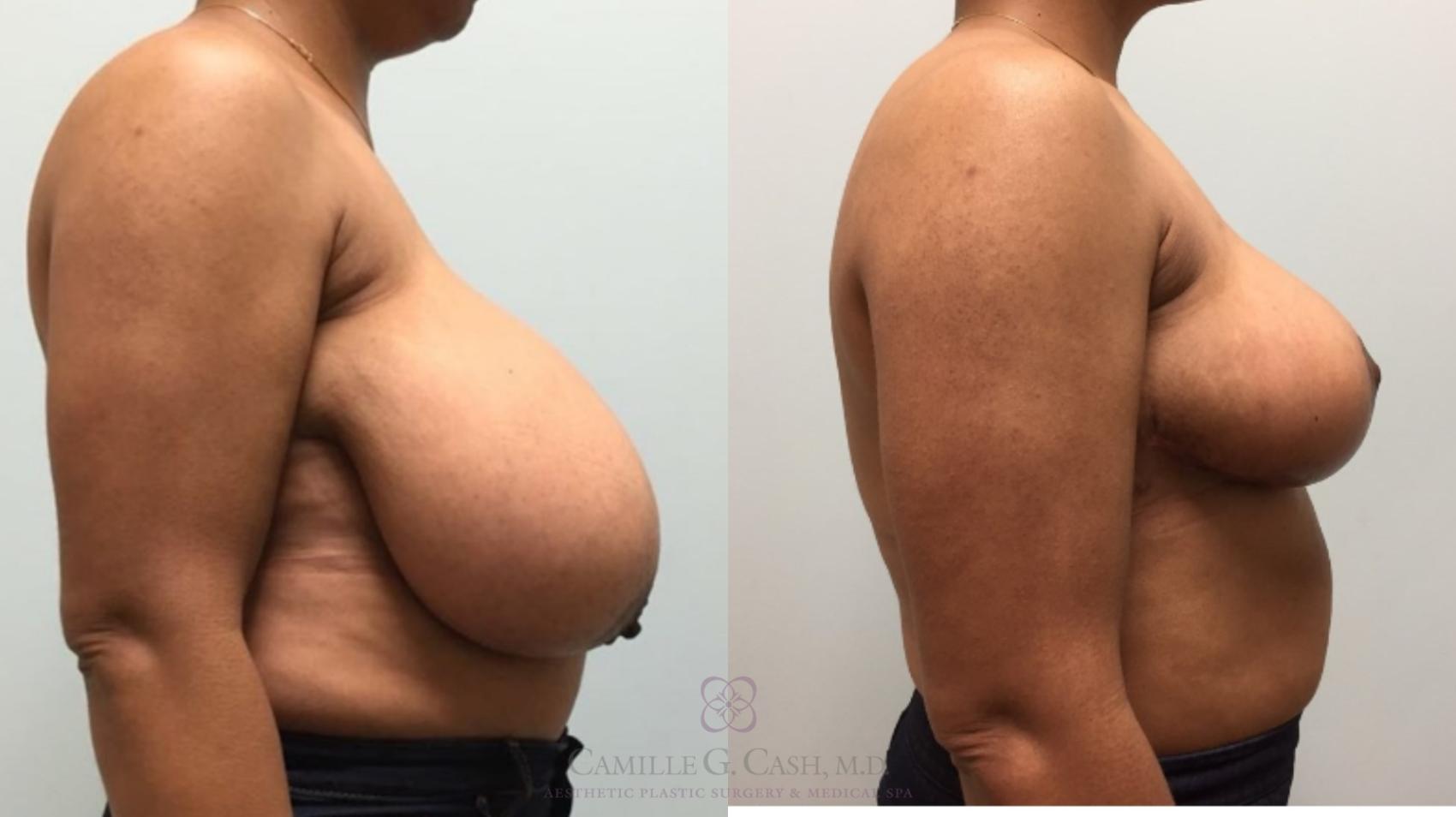 Before & After Breast Reduction Case 575 Left Side View in Houston, TX