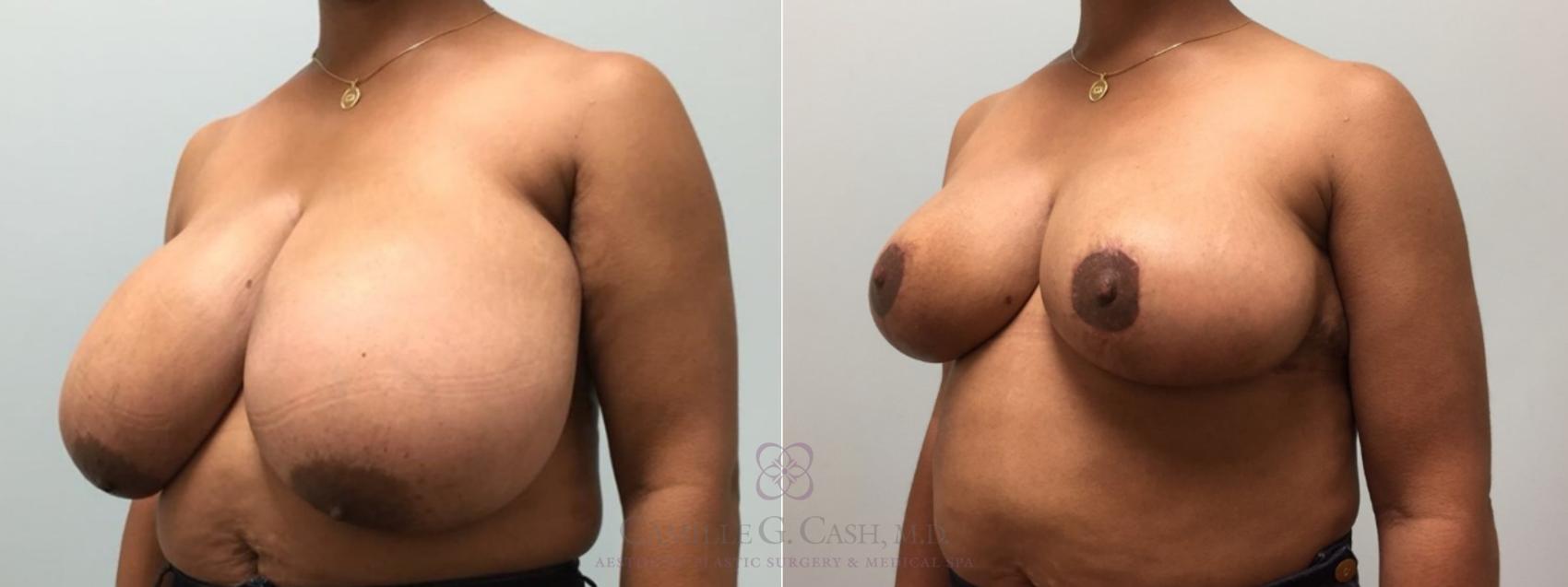 Before & After Breast Reduction Case 575 Right Oblique View in Houston, TX