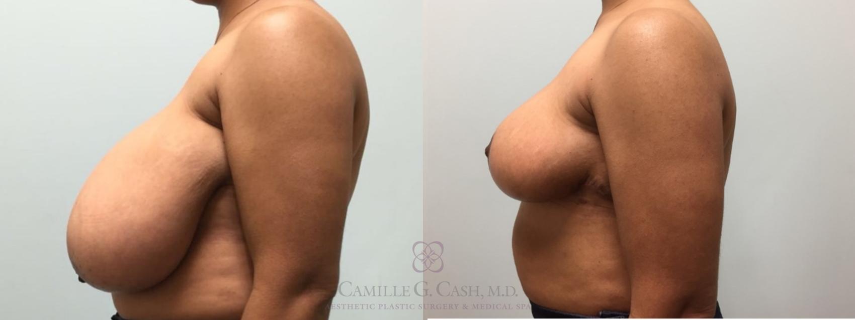 Before & After Breast Reduction Case 575 Right Side View in Houston, TX
