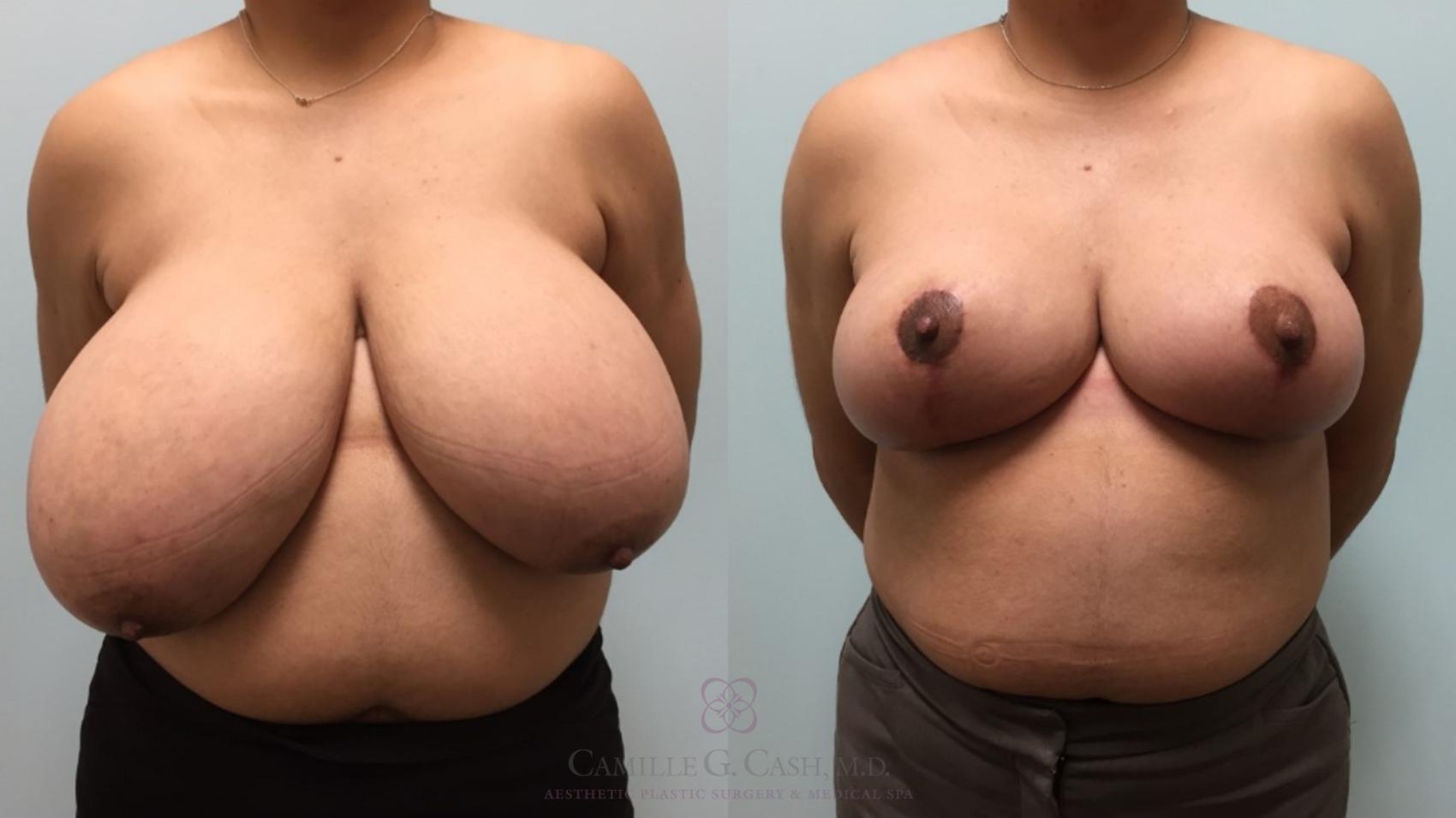 Before & After Breast Reduction Case 576 Front View in Houston, TX