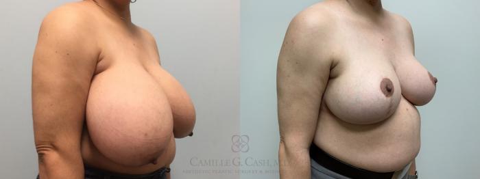 Before & After Breast Reduction Case 576 left oblique 2 years after View in Houston, TX