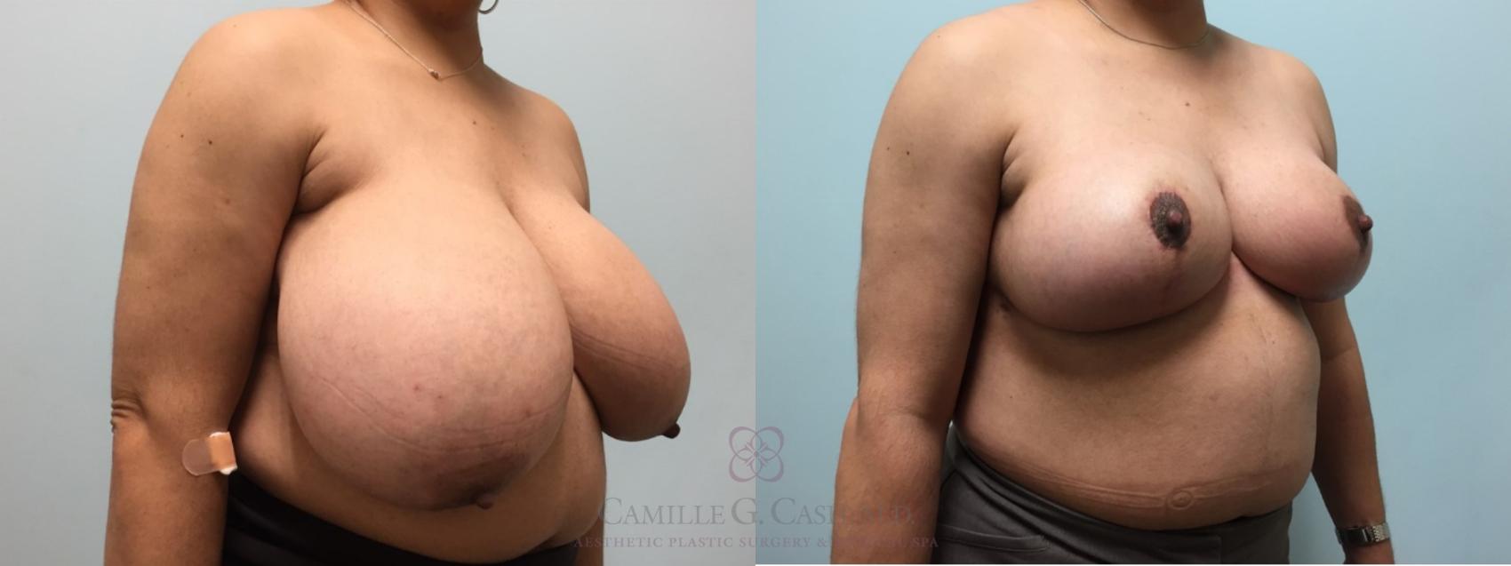 Before & After Breast Reduction Case 576 Left Oblique View in Houston, TX