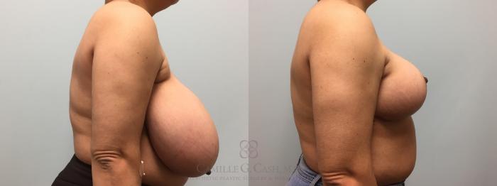 Before & After Breast Reduction Case 576 Left Side View in Houston, TX