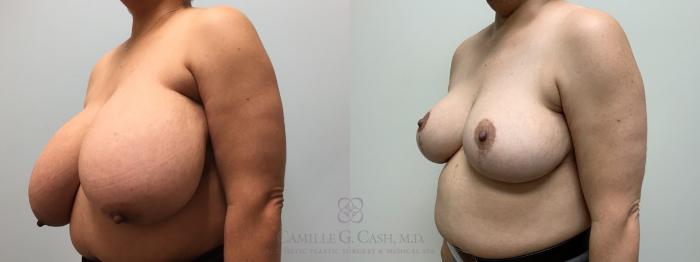Before & After Breast Reduction Case 576 right oblique befoe and 2 years after View in Houston, TX