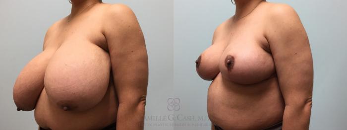 Before & After Breast Reduction Case 576 Right Oblique View in Houston, TX