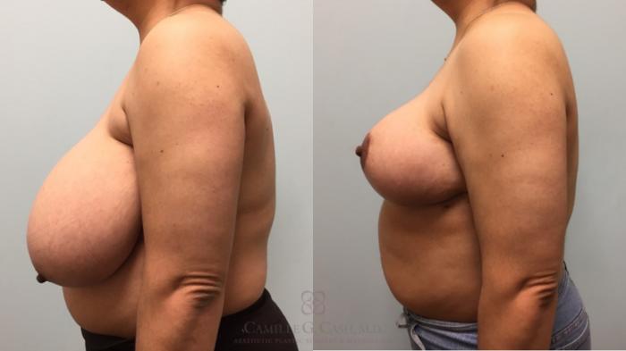 Before & After Breast Reduction Case 576 Right Side View in Houston, TX