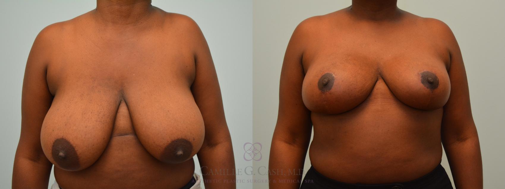 Before & After Breast Reduction Case 578 Front View in Houston, TX