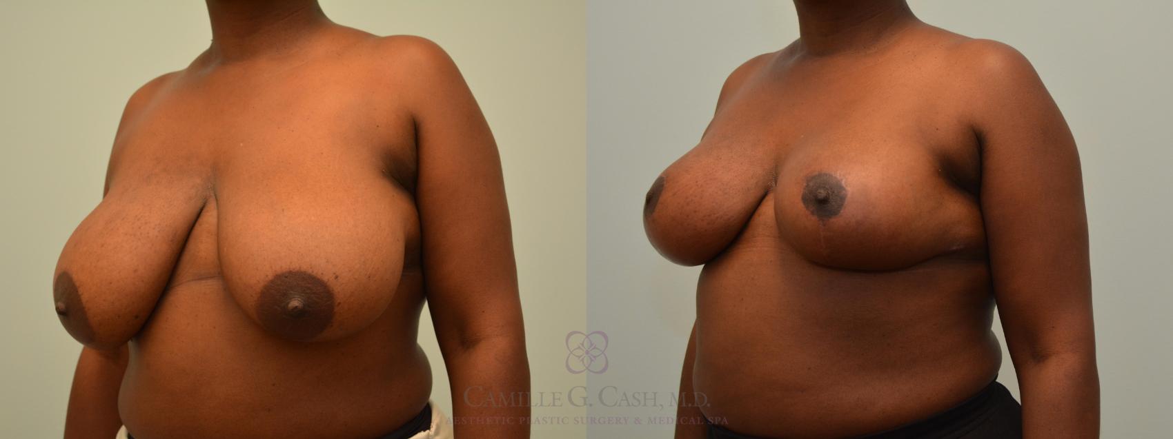 Before & After Breast Reduction Case 578 Left Oblique View in Houston, TX
