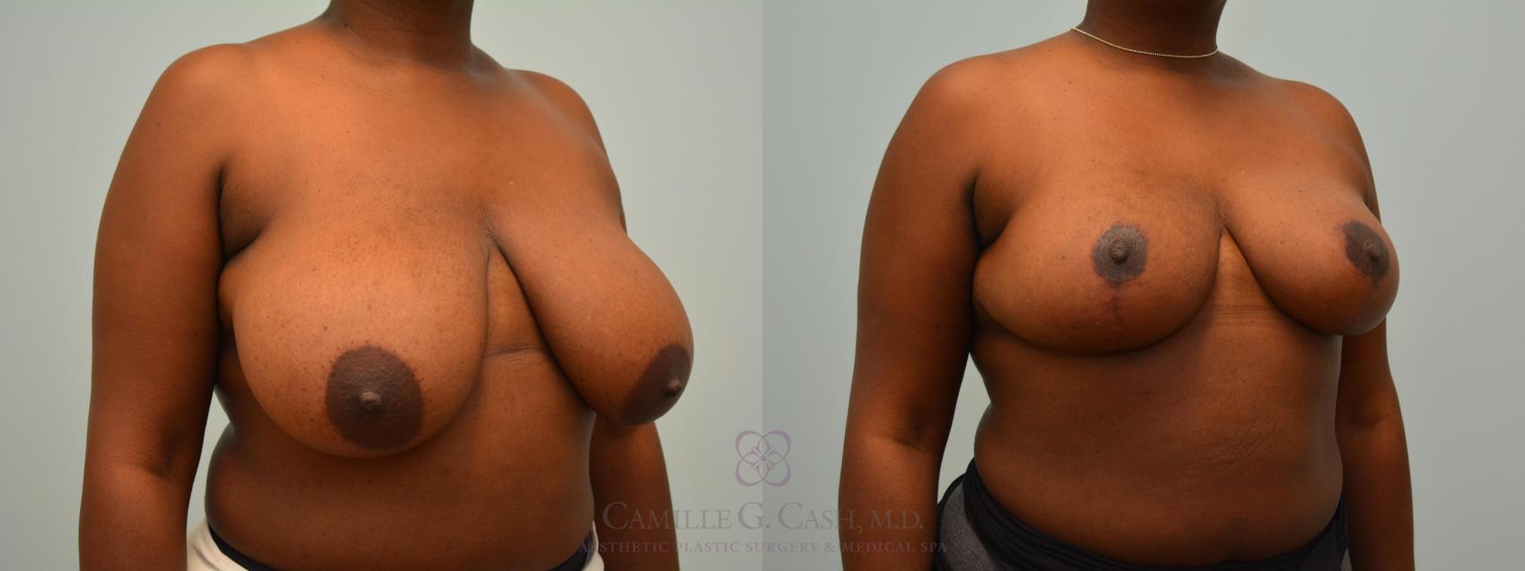 Before & After Breast Reduction Case 578 Right Oblique View in Houston, TX