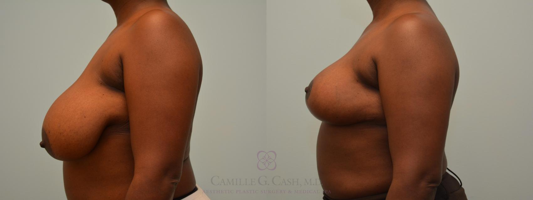Before & After Breast Reduction Case 578 Right Side View in Houston, TX