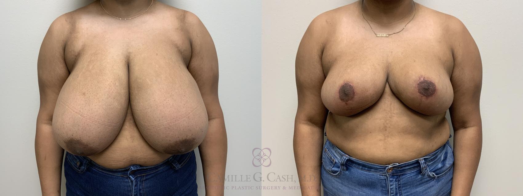 Before & After Breast Reduction Case 581 Front View in Houston, TX