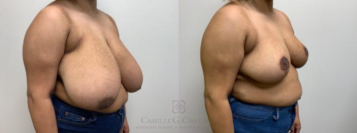 Before & After Breast Reduction Case 581 Left Oblique View in Houston, TX