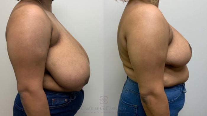 Before & After Breast Reduction Case 581 Left Side View in Houston, TX