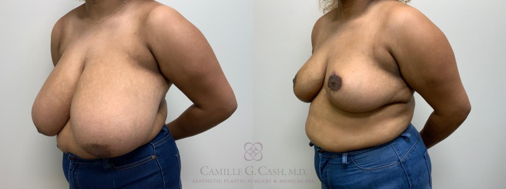 Before & After Breast Reduction Case 581 Right Oblique View in Houston, TX