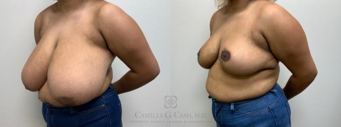 Before & After Breast Reduction Case 581 Right Oblique View in Houston, TX