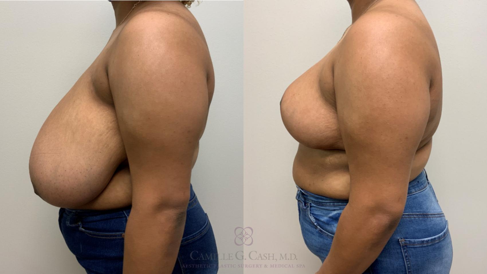 Before & After Breast Reduction Case 581 Right Side View in Houston, TX