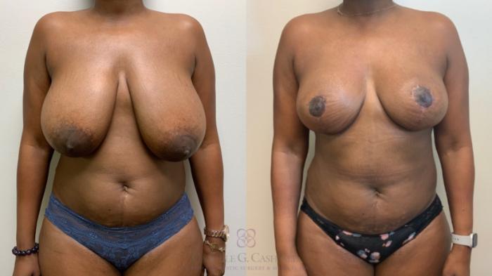 Before & After Breast Reduction Case 582 Front View in Houston, TX