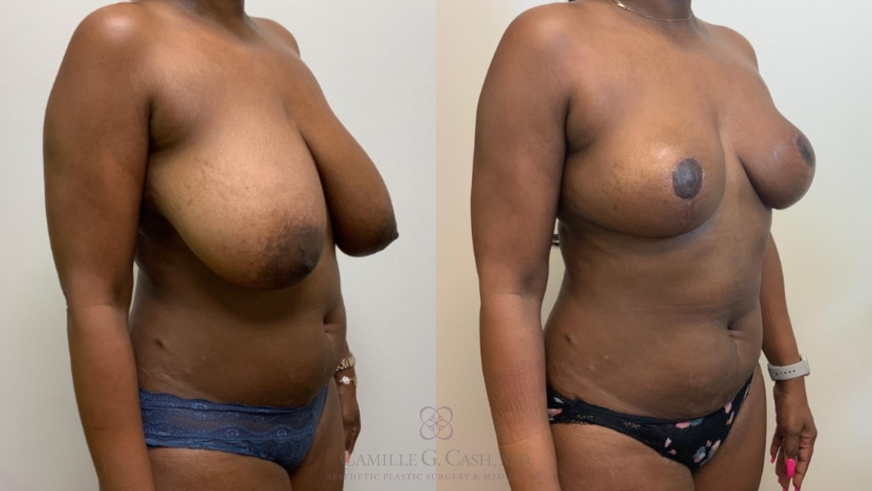 Before & After Breast Reduction Case 582 Left Oblique View in Houston, TX
