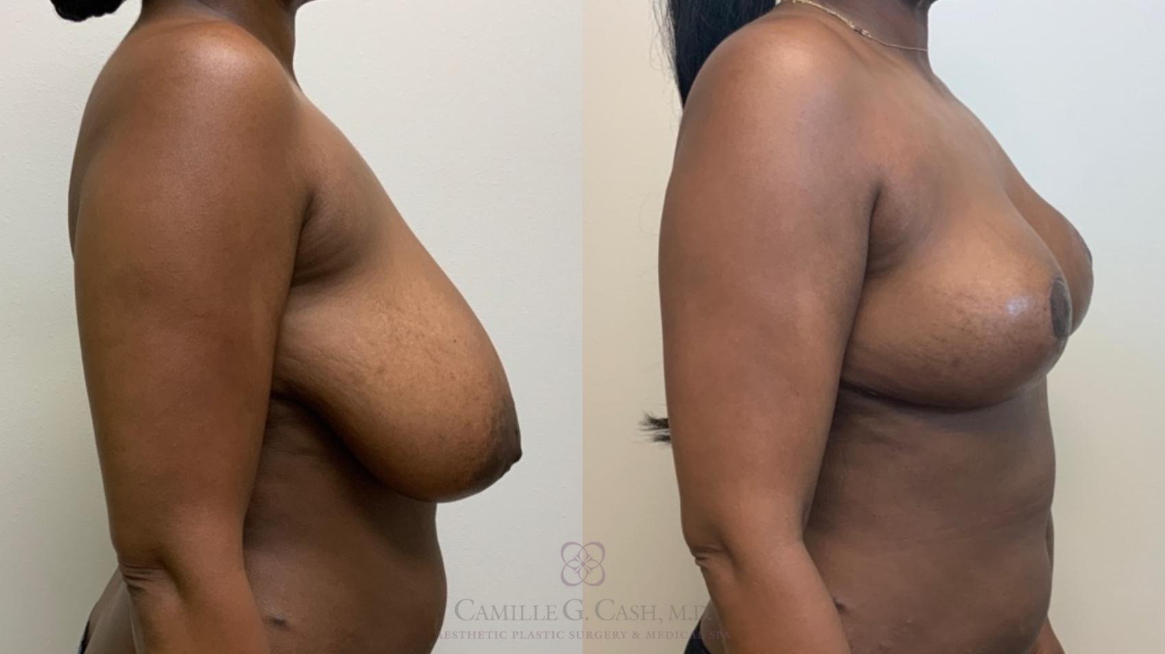 Before & After Breast Reduction Case 582 Left Side View in Houston, TX