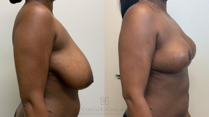 Before & After Breast Reduction Case 582 Left Side View in Houston, TX