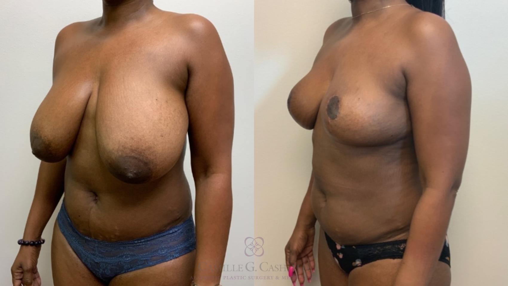 Before & After Breast Reduction Case 582 Right Oblique View in Houston, TX