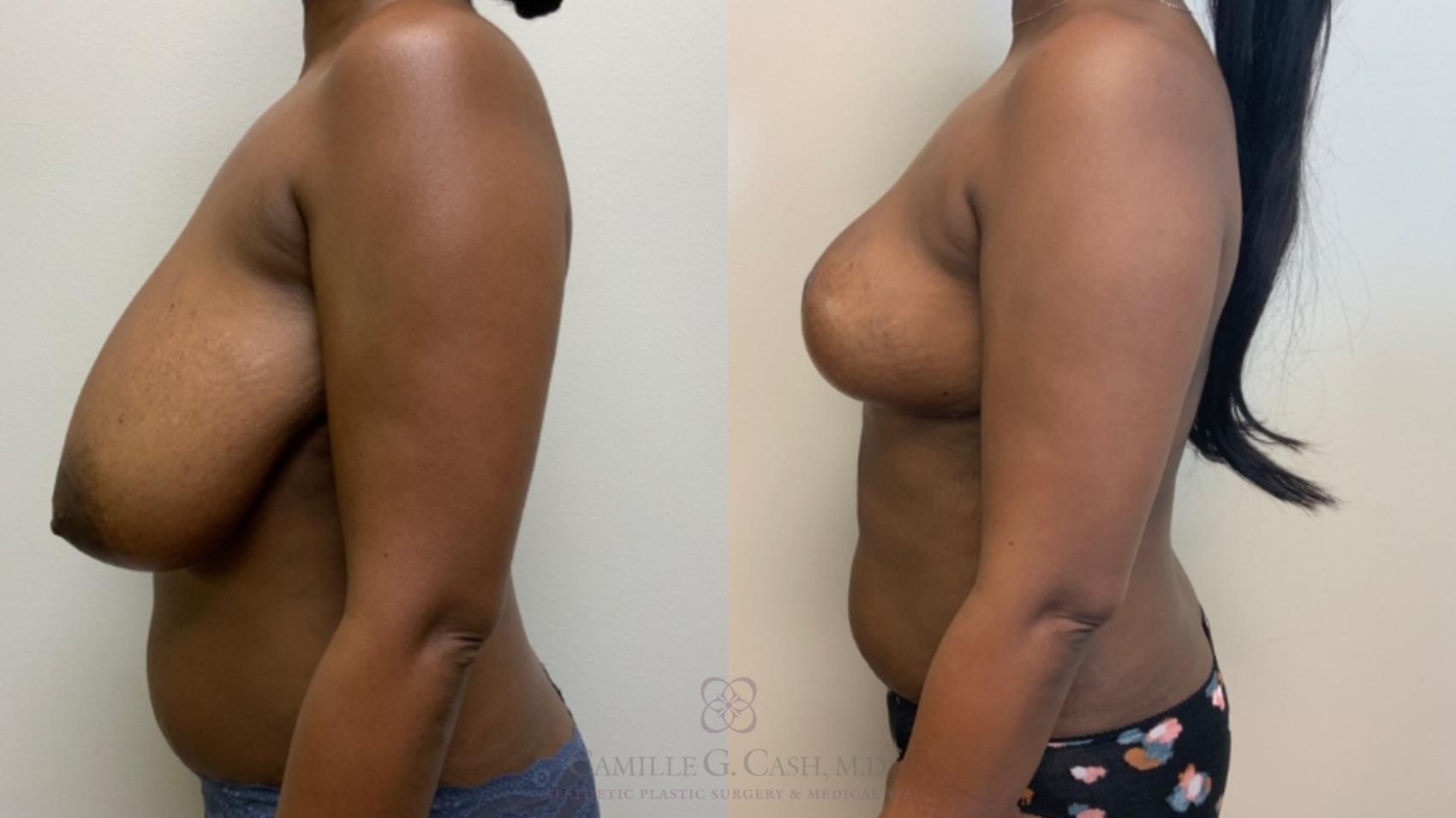 Before & After Breast Reduction Case 582 Right Side View in Houston, TX