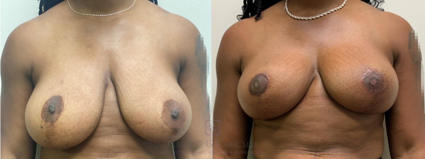 Before & After Breast Reduction Case 593 Front View in Houston, TX