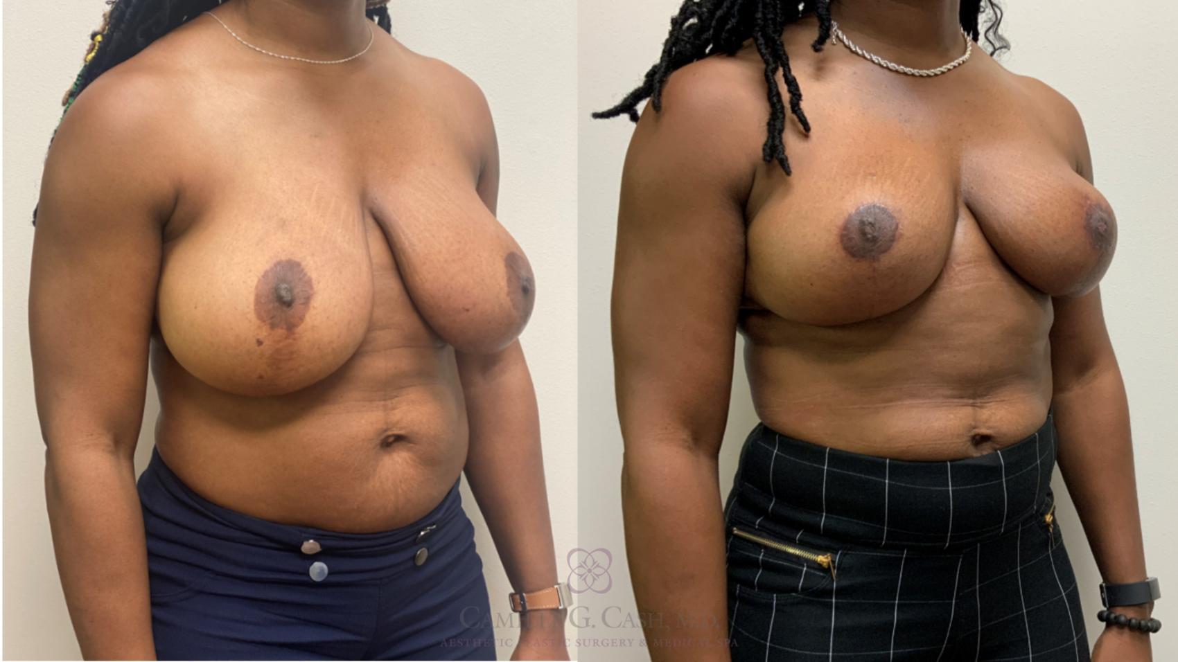 Before & After Breast Reduction Case 593 Left Oblique View in Houston, TX