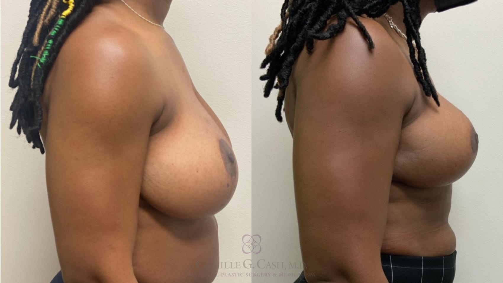 Before & After Breast Reduction Case 593 Left Side View in Houston, TX
