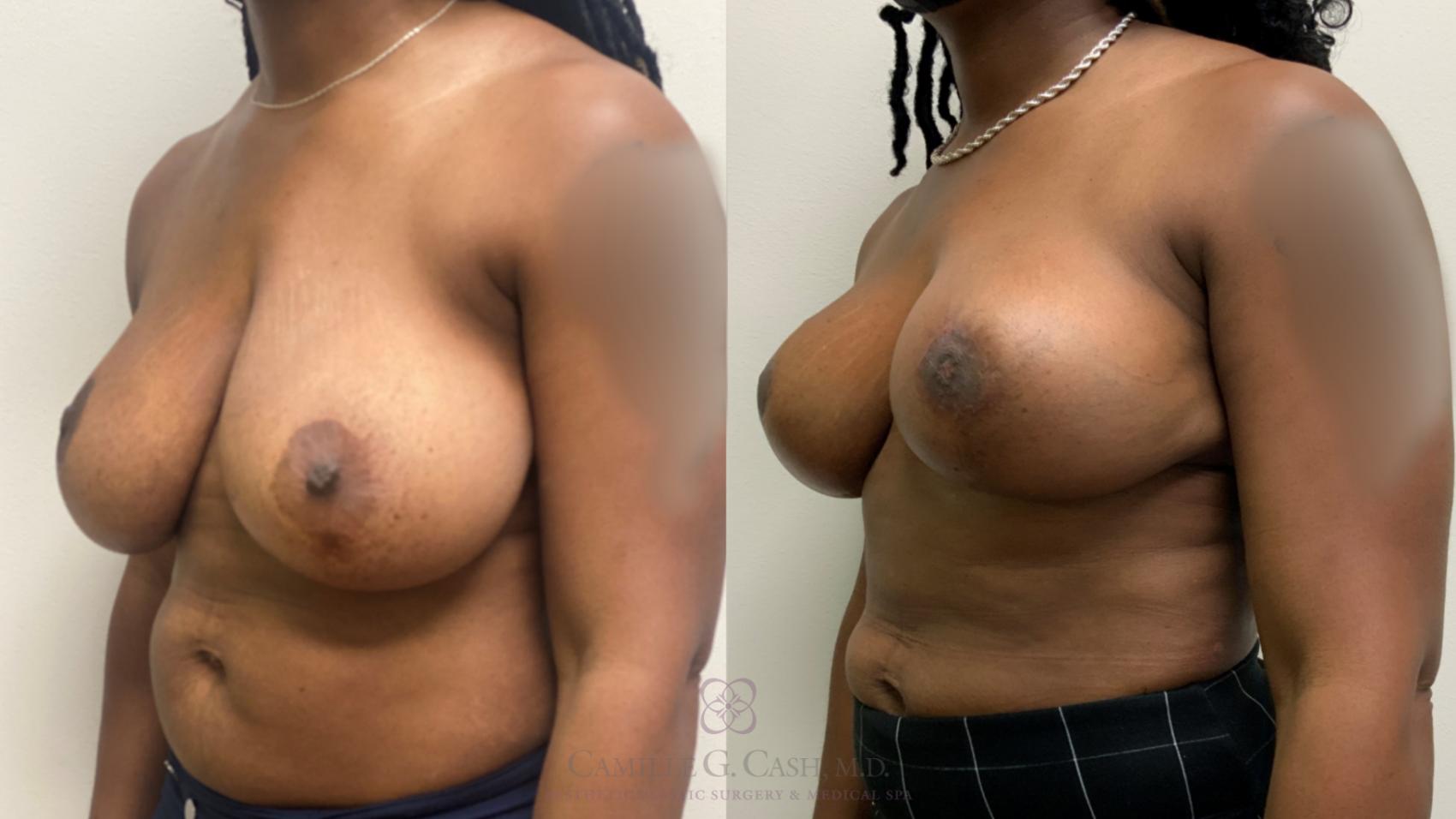 Before & After Breast Reduction Case 593 Right Oblique View in Houston, TX