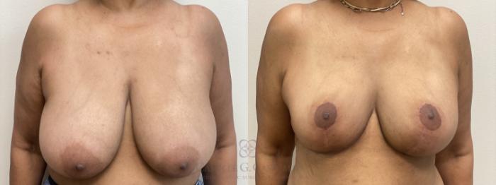 Before & After Breast Reduction Case 599 Front View in Houston, TX