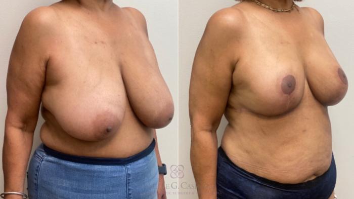 Before & After Breast Reduction Case 599 Left Oblique View in Houston, TX