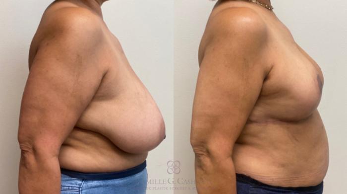 Before & After Breast Reduction Case 599 Left Side View in Houston, TX