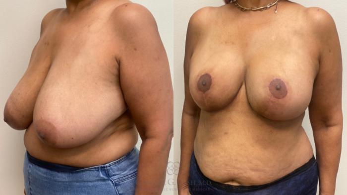 Before & After Breast Reduction Case 599 Right Oblique View in Houston, TX