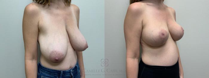 Before & After Breast Reduction Case 608 Left Oblique View in Houston, TX