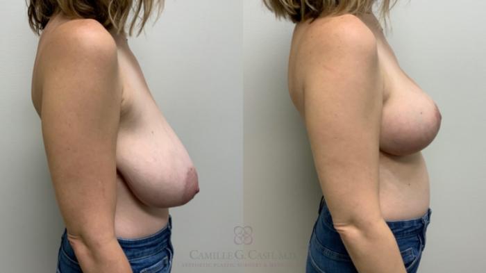 Before & After Breast Reduction Case 608 Left Side View in Houston, TX